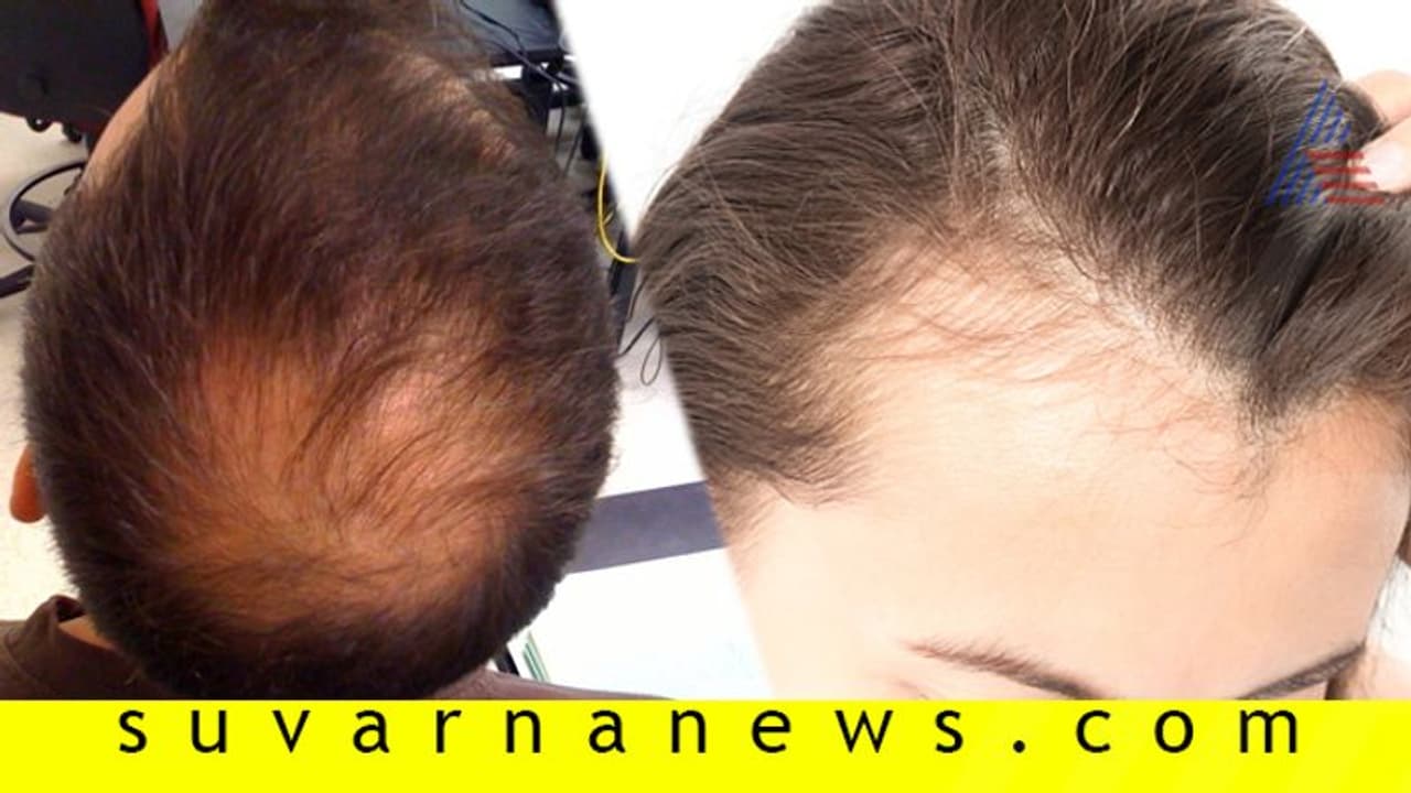 ನೀವು ಹೀಗೇ ಮಾಡುತ್ತಿದ್ದರೆ, ತಲೆ ಬೋಳಾಗುತ್ತೆ ಅಷ್ಟೇ...