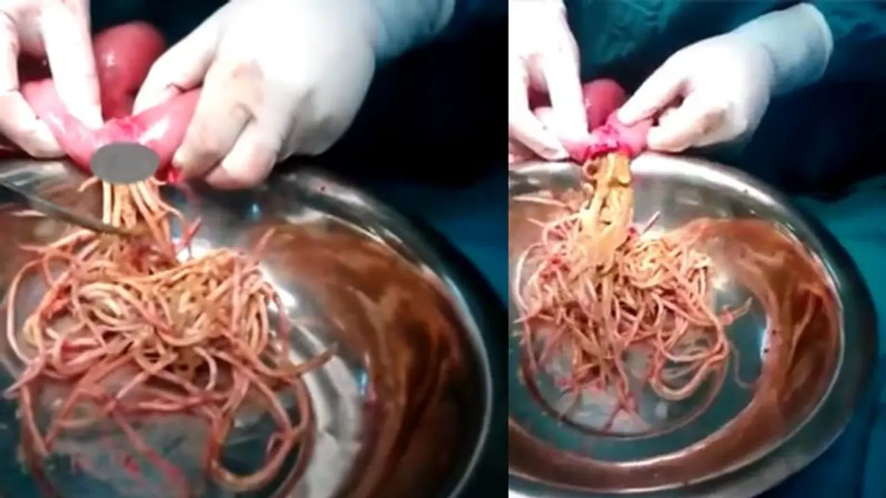 Fact Check| ನೂಡಲ್ಸ್ ಸೇವಿಸಿ, ಜೀರ್ಣವಾಗದೆ ಶಸ್ತ್ರಚಿಕಿತ್ಸೆ! Fact Check| ನೂಡಲ್ಸ್ ಸೇವಿಸಿ, ಜೀರ್ಣವಾಗದೆ ಶಸ್ತ್ರಚಿಕಿತ್ಸೆ!