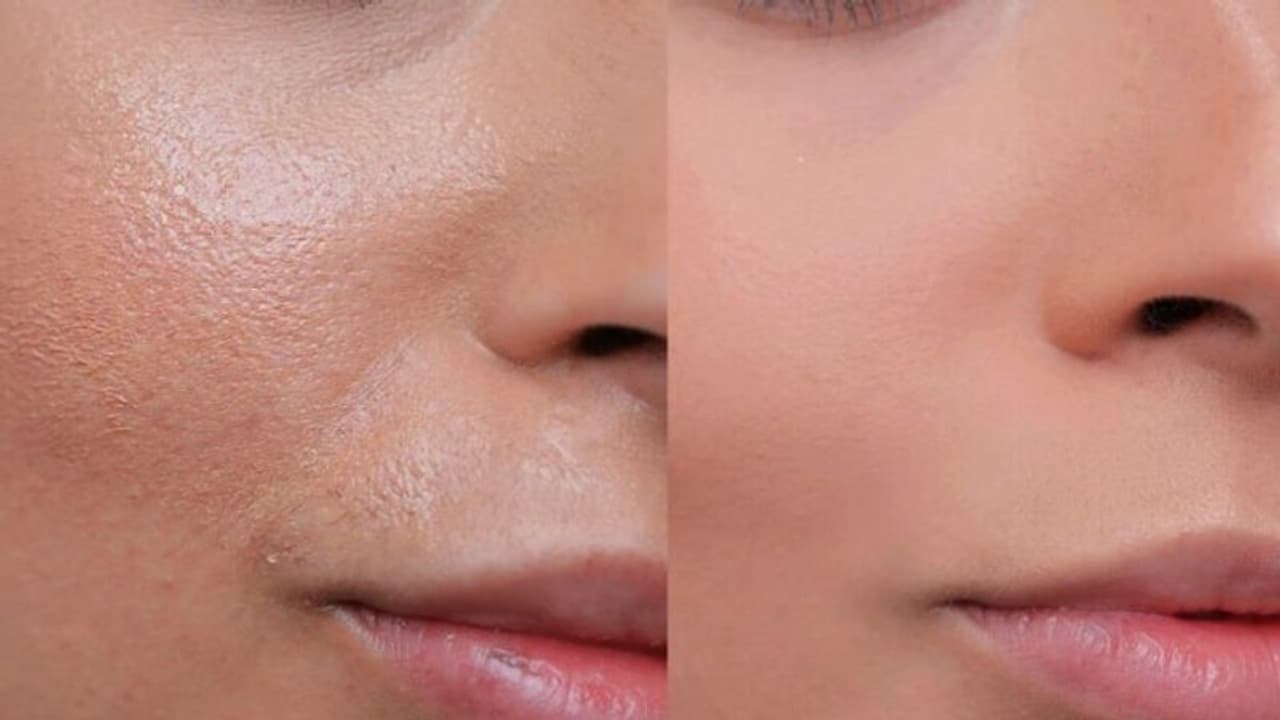 എണ്ണമയമുള്ള ചര്‍മ്മത്തിന് ഇക്കാര്യങ്ങള്‍ പരീക്ഷിക്കാം...