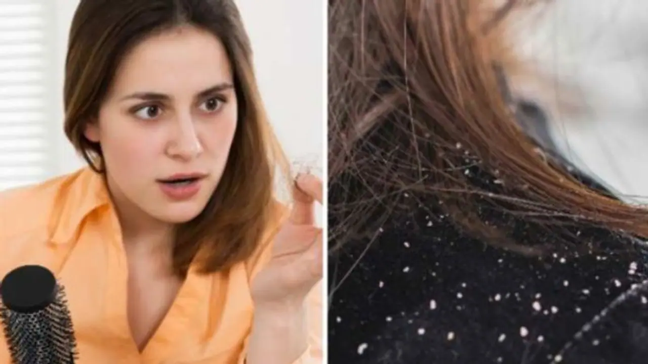 മഴക്കാലത്തെ താരന്; ഒഴിവാക്കാന് ചെയ്യേണ്ടത്... മഴക്കാലത്തെ താരന്; ഒഴിവാക്കാന് ചെയ്യേണ്ടത്...