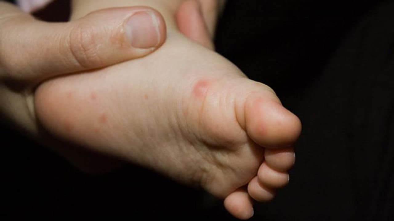 Tomato fever : 'തക്കാളിപ്പനി'യോ? എന്താണത്!, ലക്ഷണങ്ങളും കാരണങ്ങളും പരിചരണവും