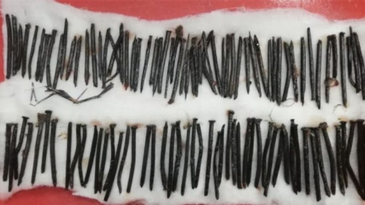 തൃശ്ശൂരില് ഒരു രോഗിയുടെ വയറ്റിൽ നിന്ന് പുറത്തെടുത്തത് 111 ആണികൾ ! തൃശ്ശൂരില് ഒരു രോഗിയുടെ വയറ്റിൽ നിന്ന് പുറത്തെടുത്തത് 111 ആണികൾ !