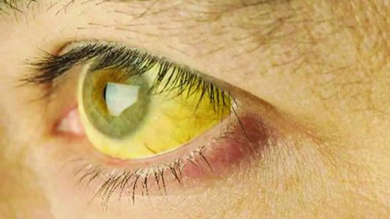 രണ്ട് പേര്‍ മരിച്ചു, 180 പേര്‍ക്ക് മഞ്ഞപ്പിത്തം സ്ഥിരീകരിച്ചു; എറണാകുളത്ത് 2 പഞ്ചായത്തുകളിൽ അതീവ ജാഗ്രത