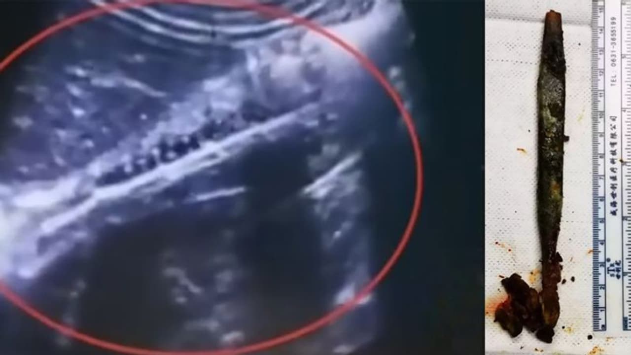 20 साल तक पेट में सड़ रहा था ब्रश, फिर... 20 साल तक पेट में सड़ रहा था ब्रश, फिर...