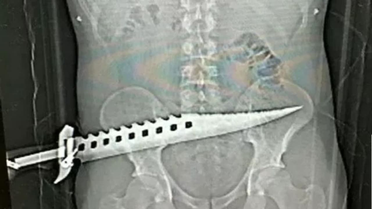 കഠാര മുഴുവനായും ശരീരത്തിലേക്ക് കുത്തിയിറക്കി; എക്സറേ കണ്ട് അമ്പരന്ന് ഡോക്ടര്മാര് കഠാര മുഴുവനായും ശരീരത്തിലേക്ക് കുത്തിയിറക്കി; എക്സറേ കണ്ട് അമ്പരന്ന് ഡോക്ടര്മാര്