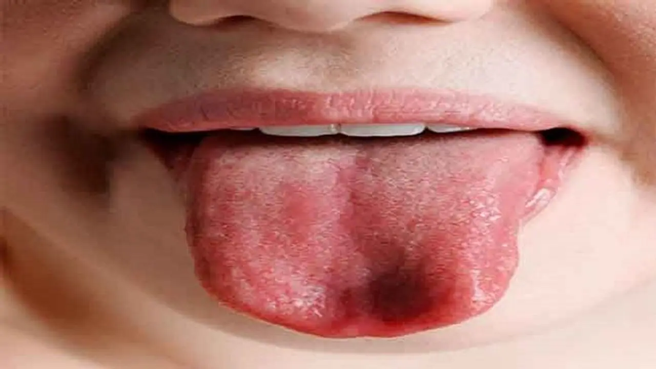 मुंह में पड़ते हों छाले तो करें ये 5 घरेलू उपाय मुंह में पड़ते हों छाले तो करें ये 5 घरेलू उपाय