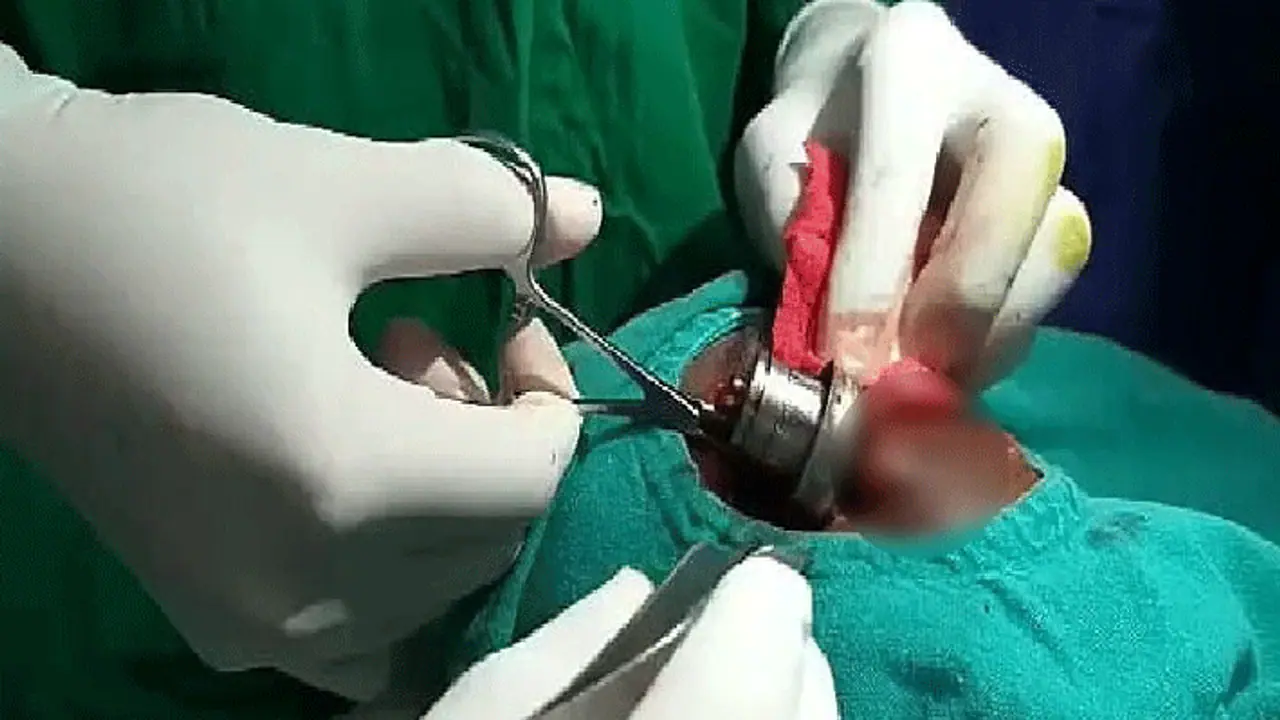 जब आंख में जा घुसी प्रेशर कुकर की सीटी, करना पड़ा ऑपरेशन, आप भी ऐसे बरतें सावधानी जब आंख में जा घुसी प्रेशर कुकर की सीटी, करना पड़ा ऑपरेशन, आप भी ऐसे बरतें सावधानी