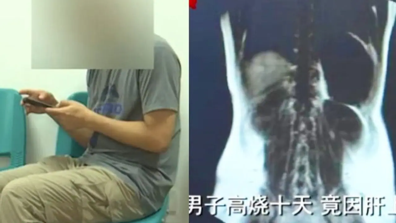 3 साल तक कच्ची मछलियां खाता रहा शख्स, पेट का हो गया ऐसा हाल