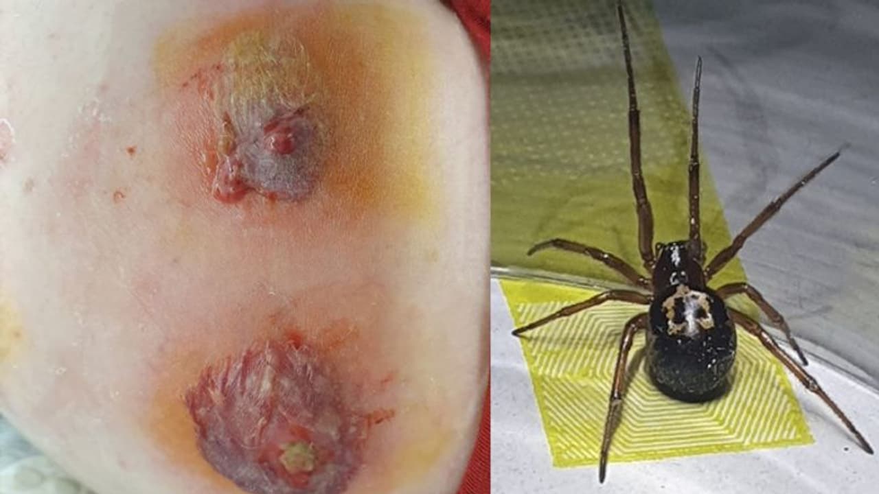 ചിലന്തിയുടെ കടിയേറ്റ യുവാവിന് സംഭവിച്ചത്; ഞെട്ടിക്കും ഈ ചിത്രങ്ങള് ചിലന്തിയുടെ കടിയേറ്റ യുവാവിന് സംഭവിച്ചത്; ഞെട്ടിക്കും ഈ ചിത്രങ്ങള്