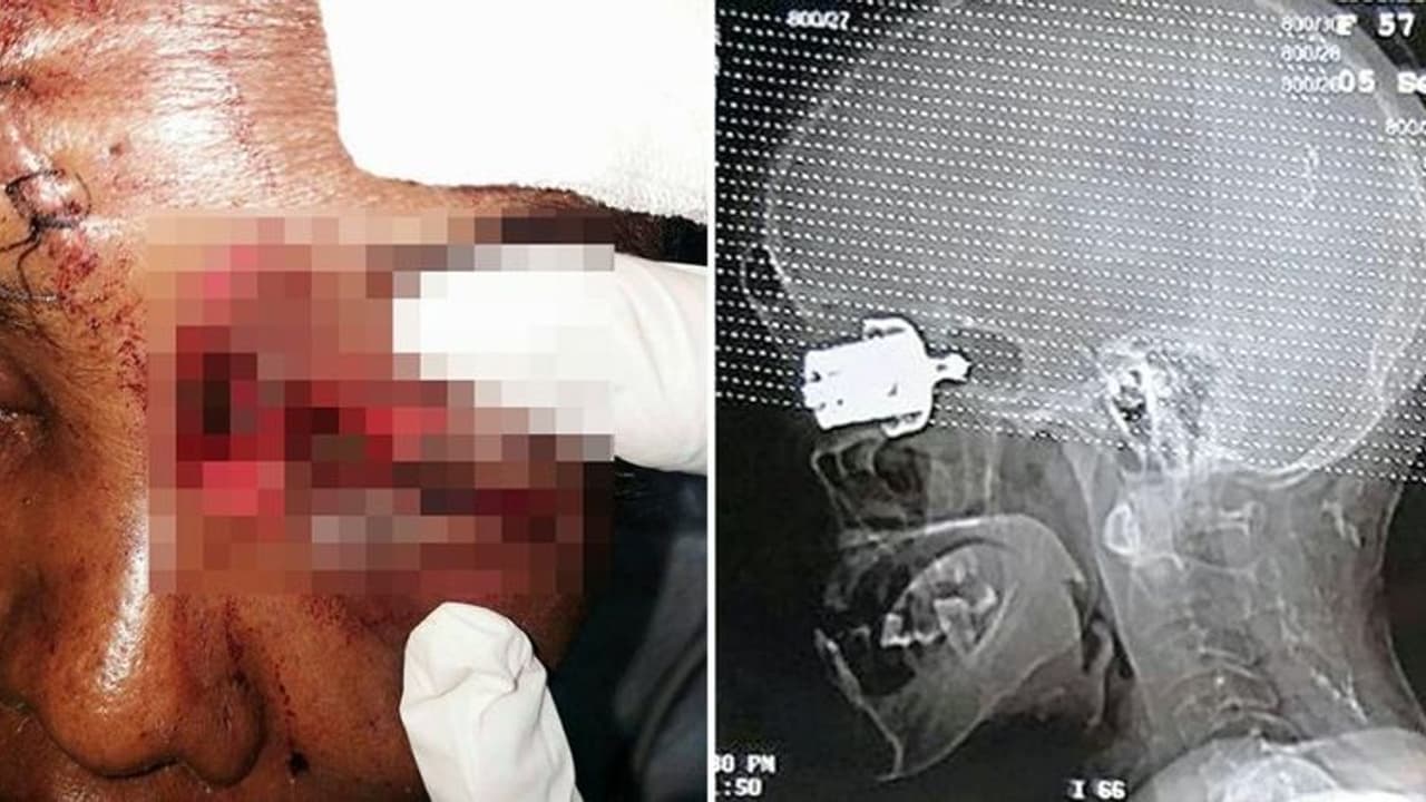 பெண்ணின் மூளையில் சிக்கிய குக்கர் விசில்.. அறுவை சிகிச்சை செய்தும் பார்வை பறிபோன பரிதாபம்!! பெண்ணின் மூளையில் சிக்கிய குக்கர் விசில்.. அறுவை சிகிச்சை செய்தும் பார்வை பறிபோன பரிதாபம்!!