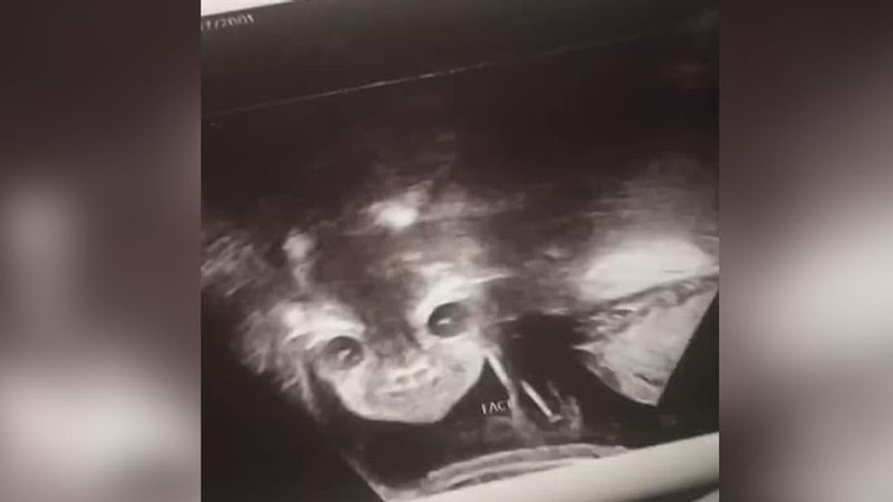 अल्ट्रासाउंड करवाने पहुंची महिला, गर्भ में दिखा 'शैतान' अल्ट्रासाउंड करवाने पहुंची महिला, गर्भ में दिखा 'शैतान'