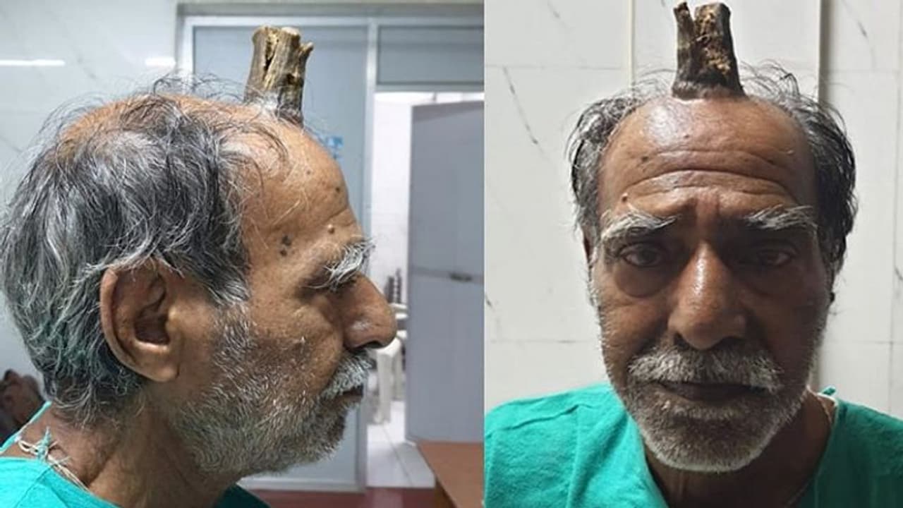 इस शख्स के सिर पर निकला सींग, डॉक्टर भी रह गए हैरान इस शख्स के सिर पर निकला सींग, डॉक्टर भी रह गए हैरान