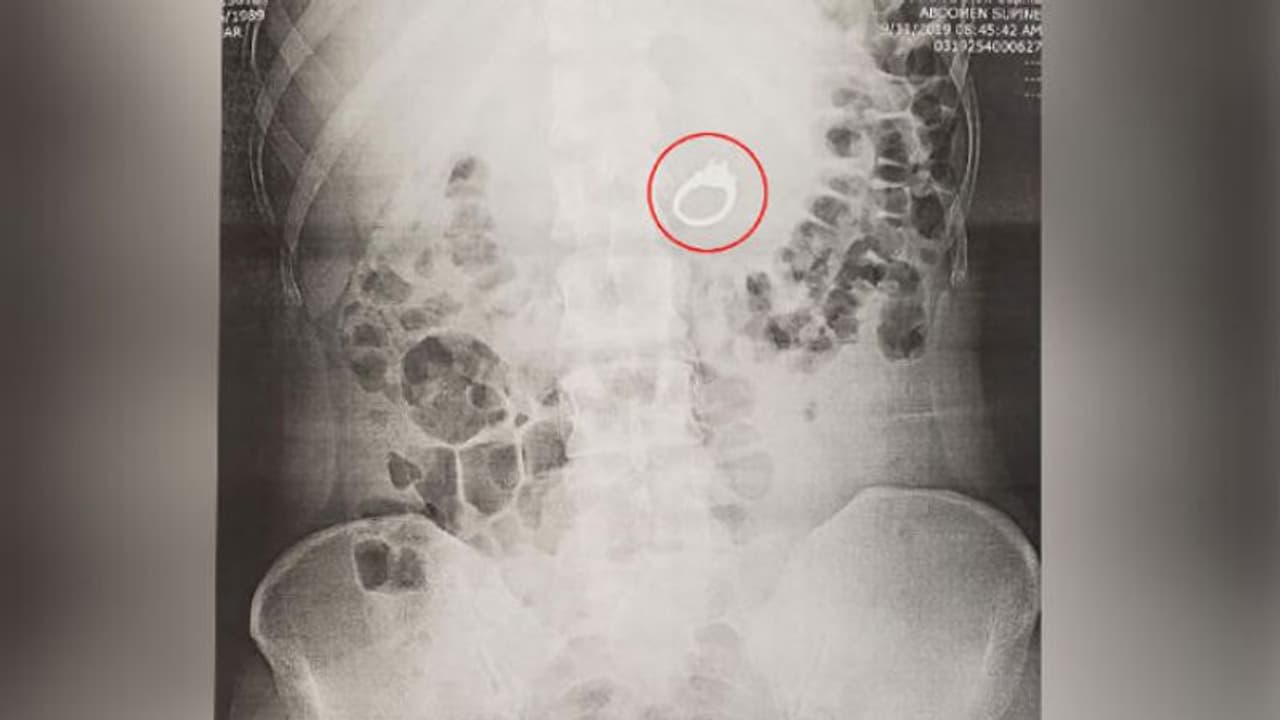 വിവാഹമോതിരം വിഴുങ്ങുന്നതായി സ്വപ്നം കണ്ടു; ഉണര്ന്നപ്പോള് കണ്ടത്... വിവാഹമോതിരം വിഴുങ്ങുന്നതായി സ്വപ്നം കണ്ടു; ഉണര്ന്നപ്പോള് കണ്ടത്...