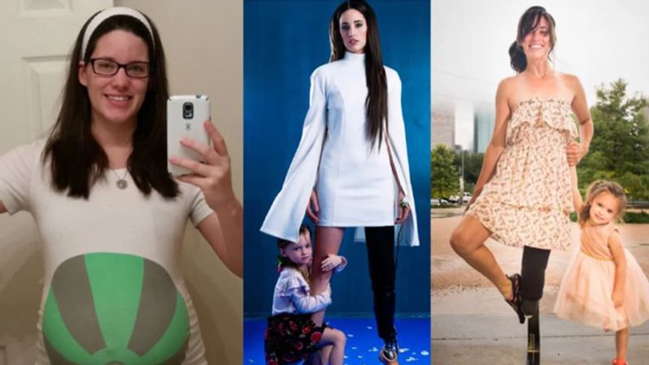 ഗർഭപാത്രത്തിൽ വളരുന്ന കുഞ്ഞിന് വേണ്ടി സ്വന്തം കാൽ മുറിച്ച് മാറ്റി ഒരമ്മ