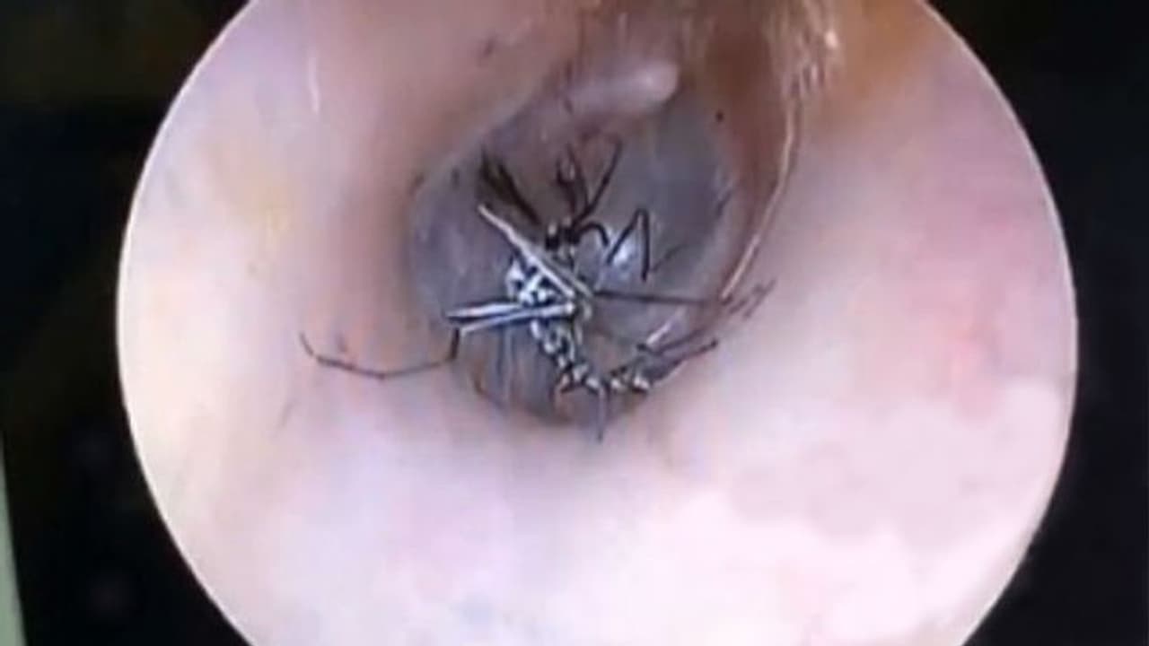 ചെവിയിലെപ്പോഴും മൂളല്‍, അസ്വസ്ഥതയും; ആശുപത്രിയിലെത്തിയപ്പോള്‍ കണ്ടത്...