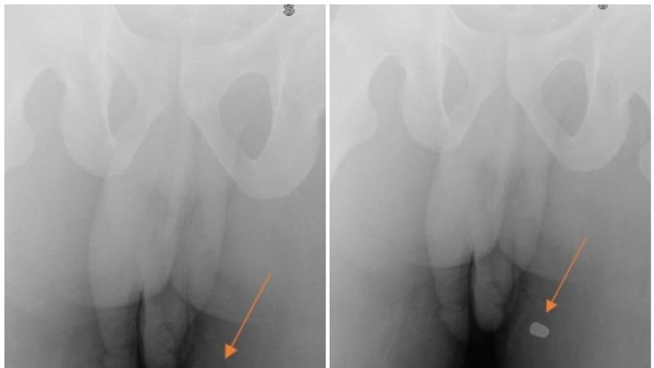 അബദ്ധത്തില് കാഞ്ചി വലിച്ചു; യുവാവിന്റെ ലിംഗം തുളച്ച് വെടിയുണ്ട അബദ്ധത്തില് കാഞ്ചി വലിച്ചു; യുവാവിന്റെ ലിംഗം തുളച്ച് വെടിയുണ്ട