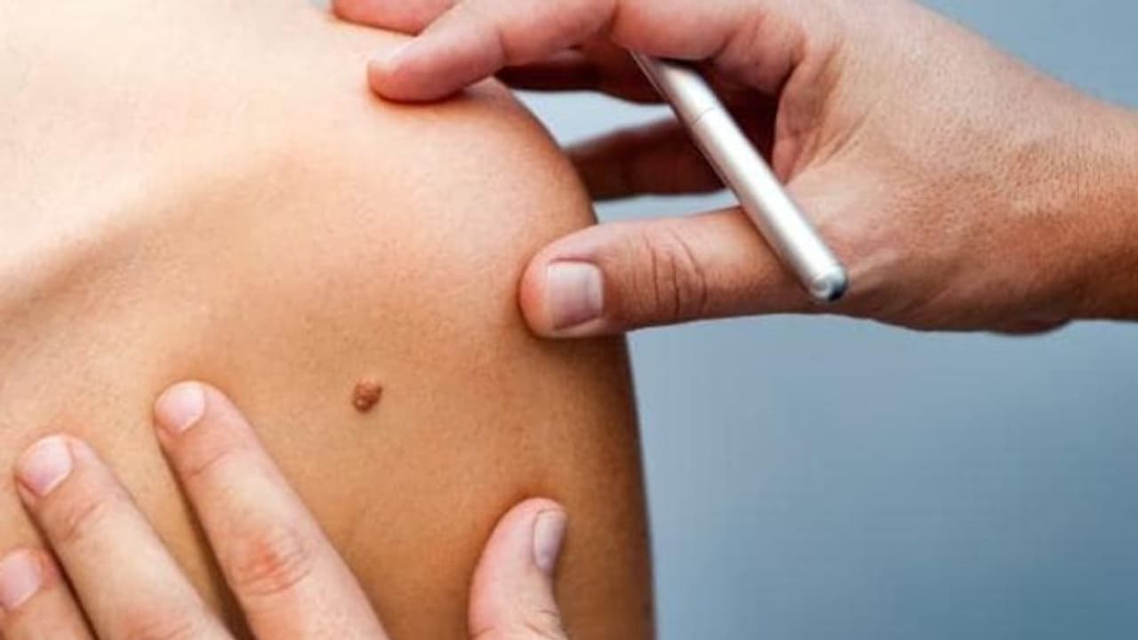 സ്കിന്‍ ക്യാന്‍സറിന്‍റെ ശ്രദ്ധിക്കാതെ പോകുന്ന ചില ലക്ഷണങ്ങള്‍...