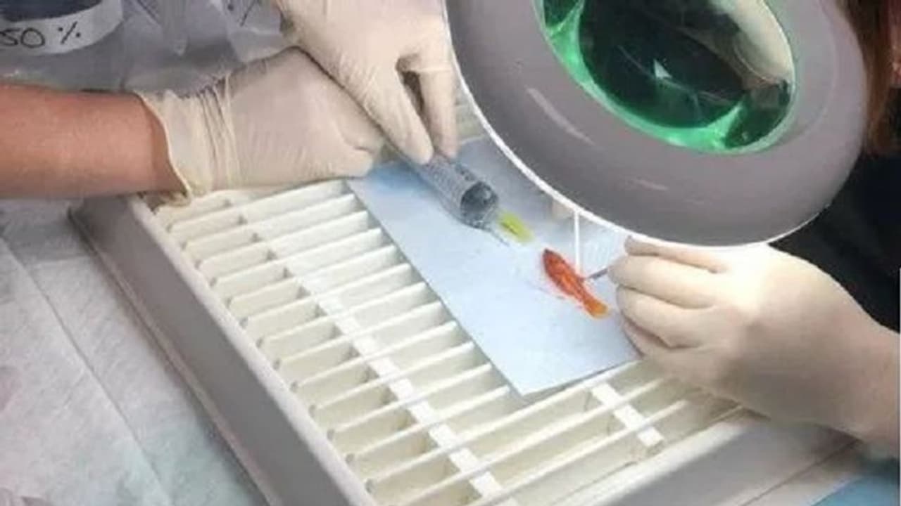 1 ಗ್ರಾಂ ಮೀನು, 40 ನಿಮಿಷ ಆಪರೇಶನ್, 8 ಸಾವಿರ ಖರ್ಚು: ಜಗತ್ತಿನ ಅತೀ ಚಿಕ್ಕ ರೋಗಿ! 1 ಗ್ರಾಂ ಮೀನು, 40 ನಿಮಿಷ ಆಪರೇಶನ್, 8 ಸಾವಿರ ಖರ್ಚು: ಜಗತ್ತಿನ ಅತೀ ಚಿಕ್ಕ ರೋಗಿ!