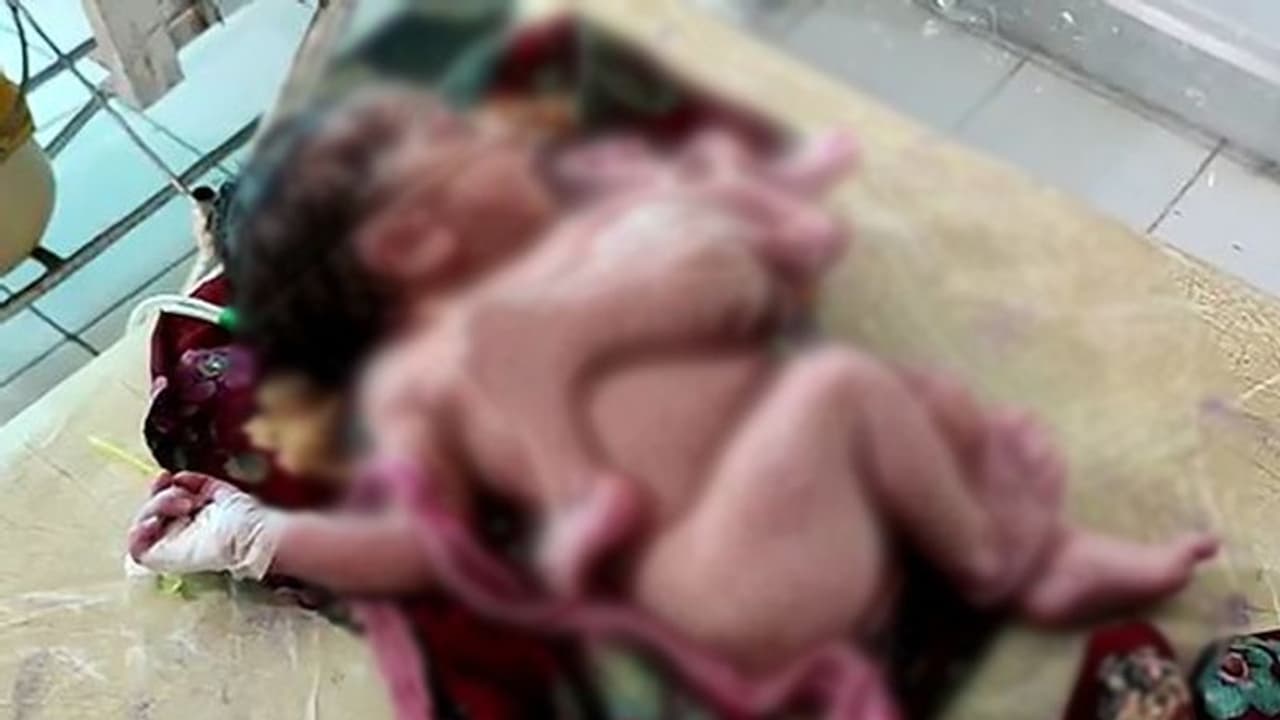 ഗര്ഭപാത്രത്തില് മൂന്ന് കുഞ്ഞുങ്ങള്, ജനിച്ചത് രണ്ടുപേര്; പെണ്കുഞ്ഞിന് നാല് കാലും മൂന്ന് കൈകളും ഗര്ഭപാത്രത്തില് മൂന്ന് കുഞ്ഞുങ്ങള്, ജനിച്ചത് രണ്ടുപേര്; പെണ്കുഞ്ഞിന് നാല് കാലും മൂന്ന് കൈകളും