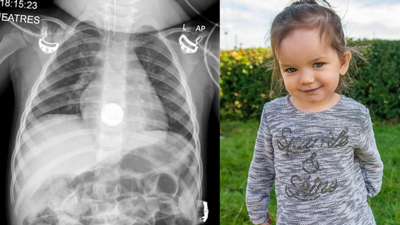 വയറുവേദനയുമായി ആശുപത്രിയിലെത്തി; എക്സ്റേയിൽ കണ്ടത്... വയറുവേദനയുമായി ആശുപത്രിയിലെത്തി; എക്സ്റേയിൽ കണ്ടത്...