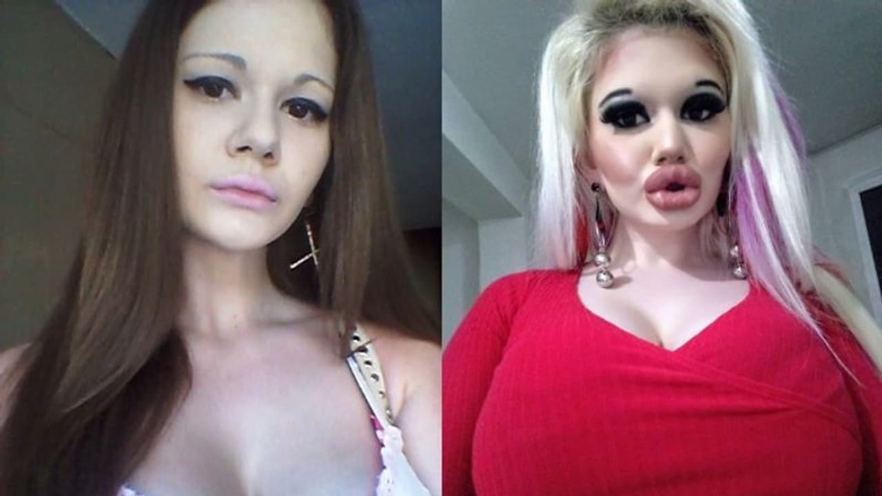 ചുണ്ടിന്റെ വലുപ്പം മൂന്നിരട്ടിയാക്കി ഇരുപത്തിരണ്ടുകാരി; കാരണം ഇതാണ്... ചുണ്ടിന്റെ വലുപ്പം മൂന്നിരട്ടിയാക്കി ഇരുപത്തിരണ്ടുകാരി; കാരണം ഇതാണ്...