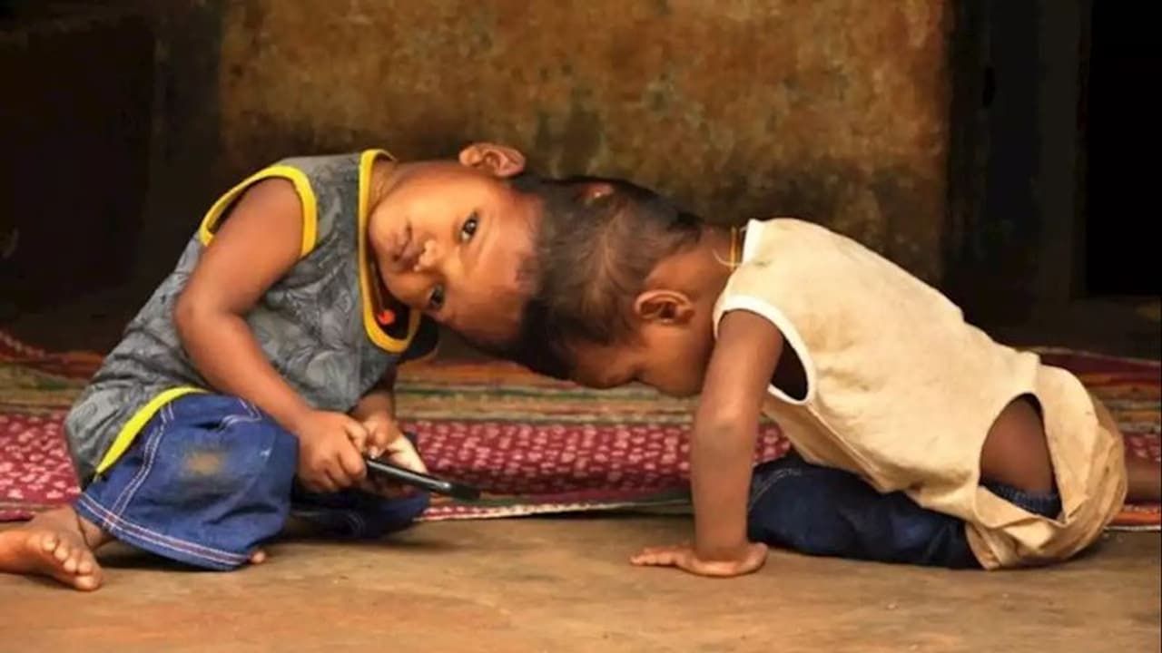 2 साल पहले अलग हुए थे जुड़वा भाइयों के सिर, एक वेंटिलेटर पर तो दूसरे का है ये हाल