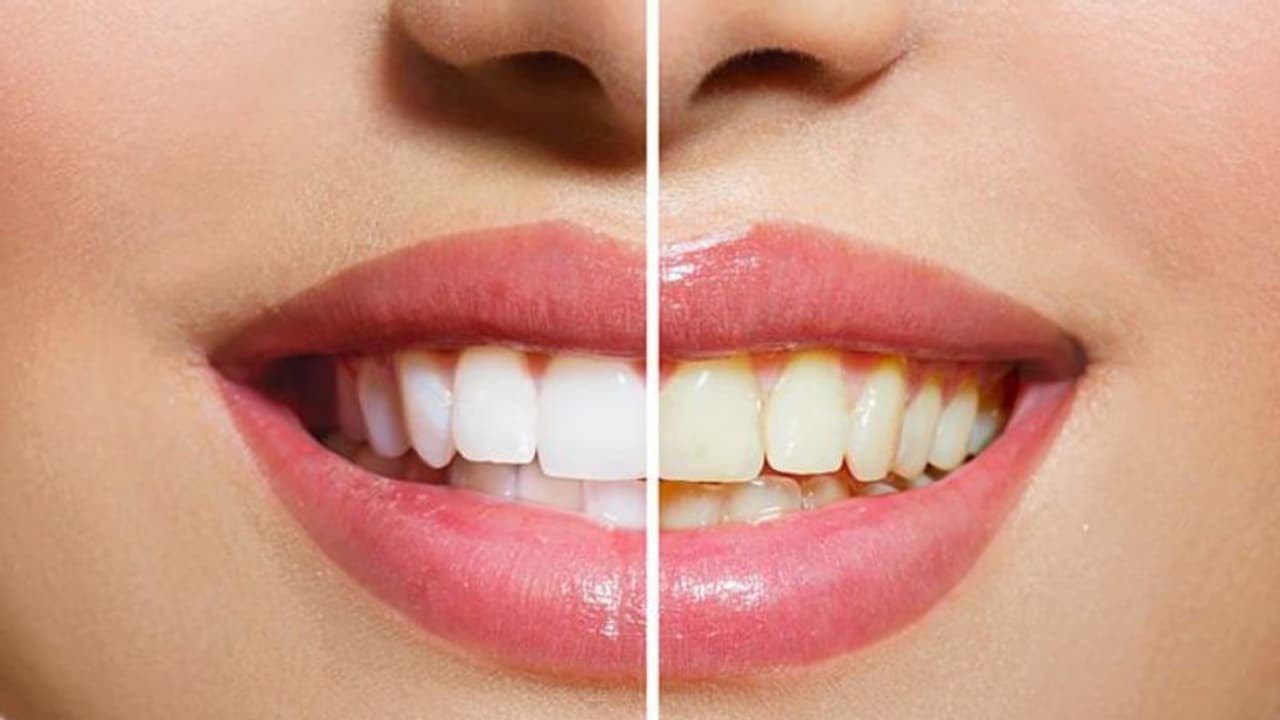 உங்கள் பற்கள் இவ்வளவு அசிங்கமா இருந்தா.. யாரும் கிட்ட வந்து கூட பேச மாட்டாங்க! செய்ய வேண்டியது என்ன?