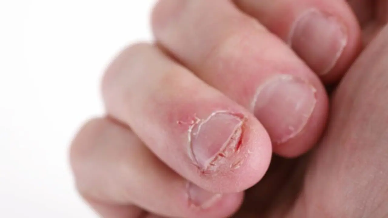 Biting nails Biting nails