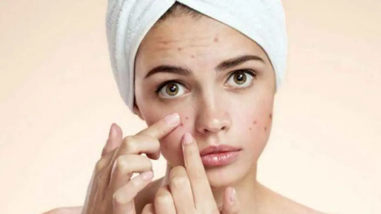Acne Problem: ಮಧ್ಯವಯಸ್ಸಲ್ಲಿ ಮೊಡವೆಯೇ? ಕಾರಣ ಅರಿಯಿರಿ