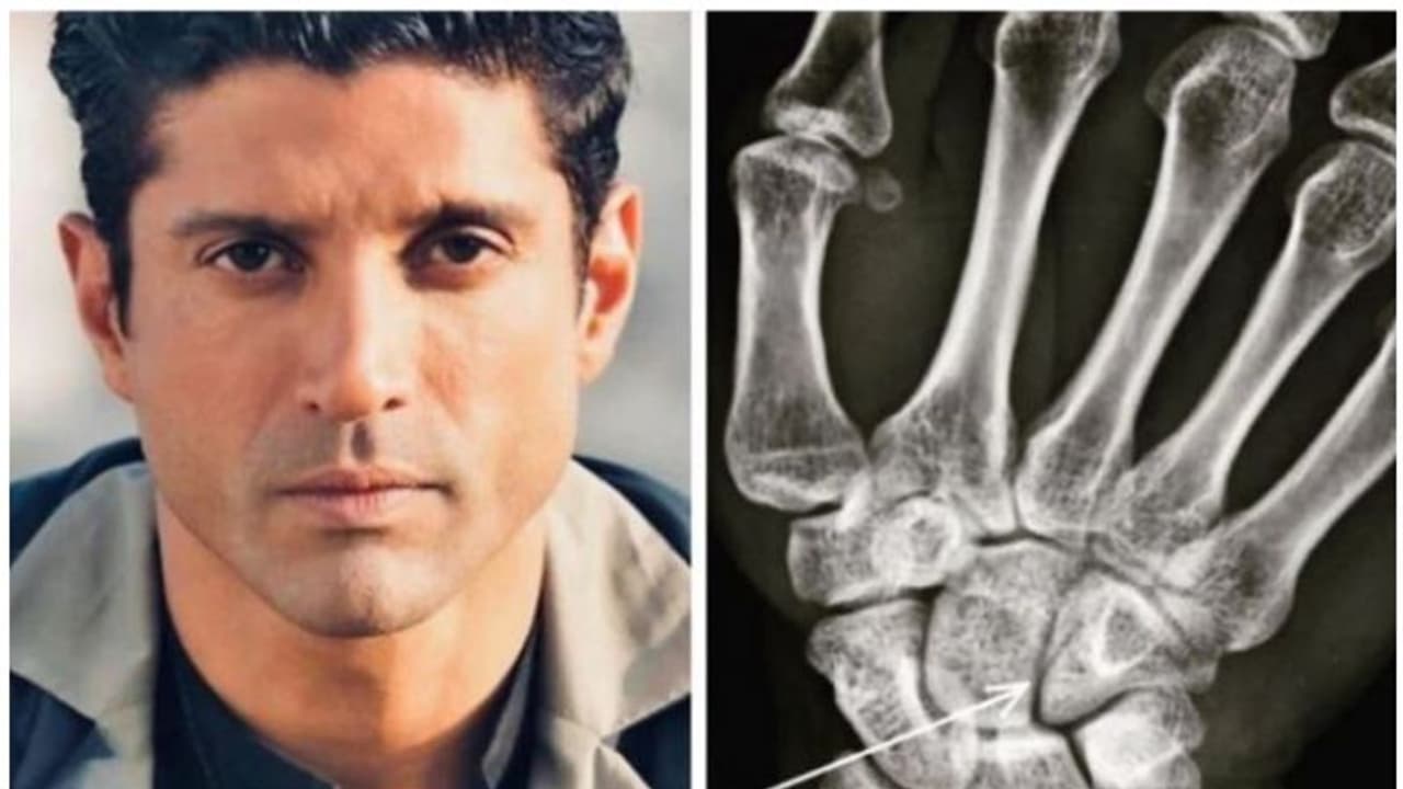 ബോക്സിംഗ് താരമായി ഫര്ഹാൻ അക്തര്, ചിത്രീകരണത്തിനിടെ പരുക്കേറ്റു ബോക്സിംഗ് താരമായി ഫര്ഹാൻ അക്തര്, ചിത്രീകരണത്തിനിടെ പരുക്കേറ്റു