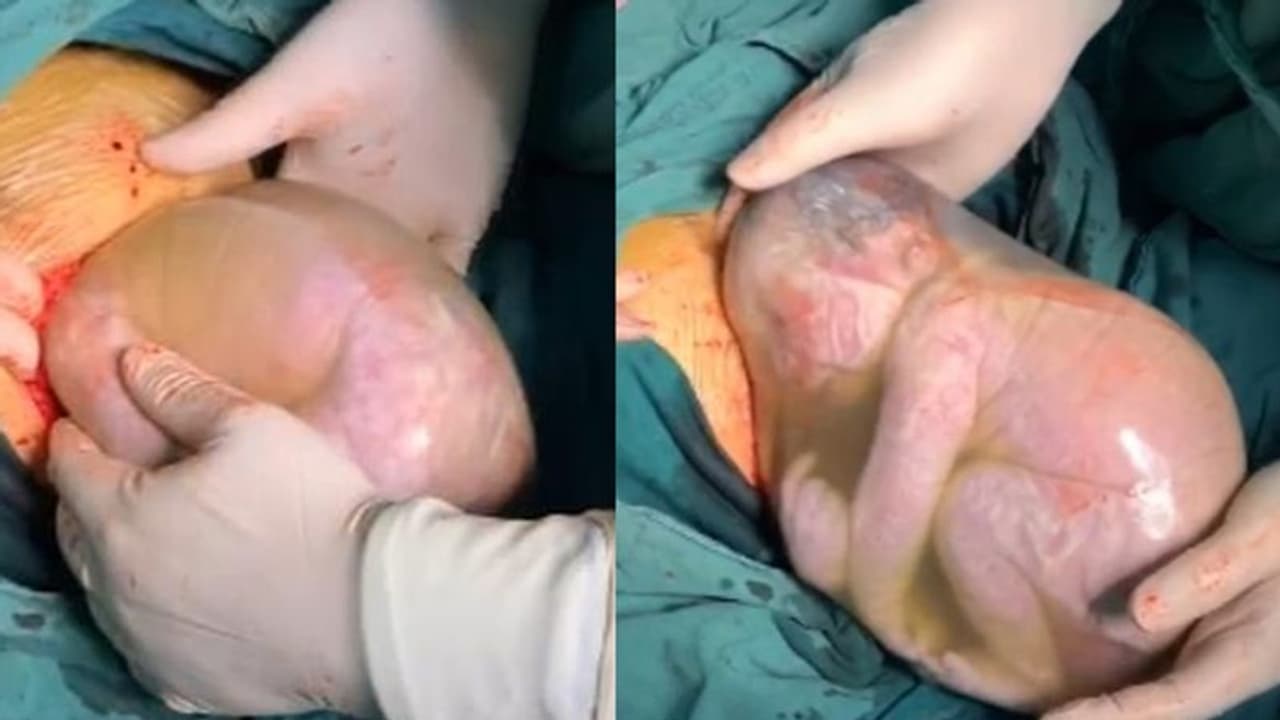 അപൂര്വ്വങ്ങളില് അപൂര്വ്വം; അമ്മയേയും കുഞ്ഞിനേയും രക്ഷിക്കാന് അസാധാരണ മാര്ഗം സ്വീകരിച്ച് ഡോക്ടര്മാര് അപൂര്വ്വങ്ങളില് അപൂര്വ്വം; അമ്മയേയും കുഞ്ഞിനേയും രക്ഷിക്കാന് അസാധാരണ മാര്ഗം സ്വീകരിച്ച് ഡോക്ടര്മാര്