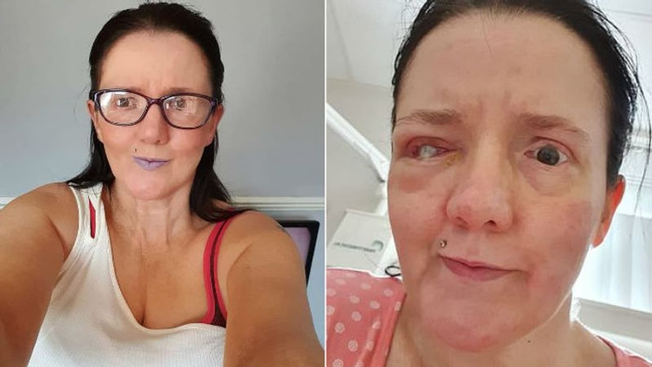 കുളിച്ച് തോര്ത്തുന്നതിനിടെ ടവല് കണ്ണില് തട്ടി; കോര്ണിയ പൊട്ടി, പഴുത്തതോടെ കണ്ണ് എടുത്തുമാറ്റി കുളിച്ച് തോര്ത്തുന്നതിനിടെ ടവല് കണ്ണില് തട്ടി; കോര്ണിയ പൊട്ടി, പഴുത്തതോടെ കണ്ണ് എടുത്തുമാറ്റി