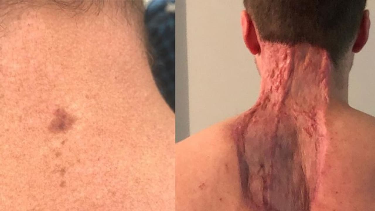 शख्स की गर्दन पर अचानक दिखा छोटा सा तिल, इसके बाद हो गया खौफनाक हाल शख्स की गर्दन पर अचानक दिखा छोटा सा तिल, इसके बाद हो गया खौफनाक हाल