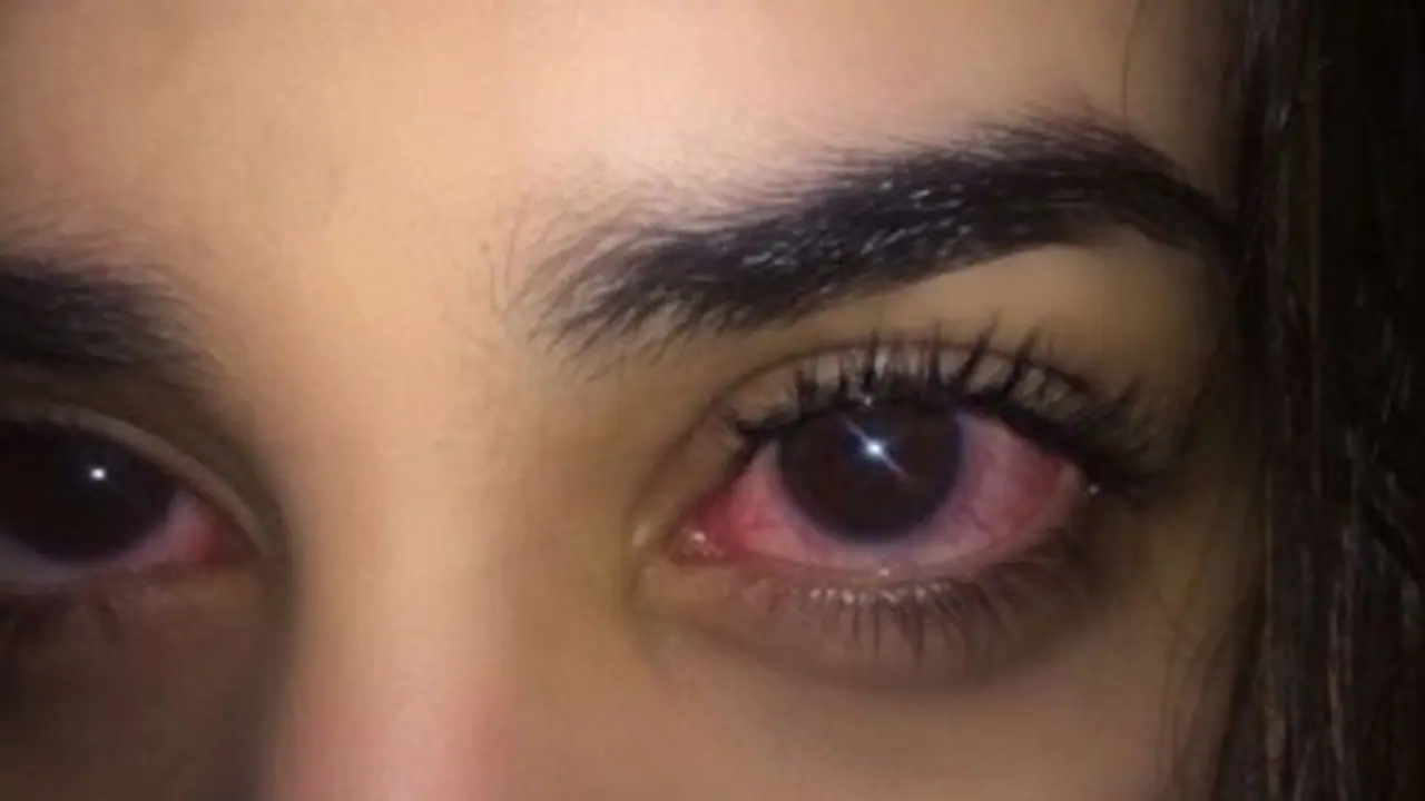 छुट्टियों में लगातार इस्तेमाल करती रही स्मार्टफोन, फिर आंखों की पुतलियों हो गई बर्बाद छुट्टियों में लगातार इस्तेमाल करती रही स्मार्टफोन, फिर आंखों की पुतलियों हो गई बर्बाद