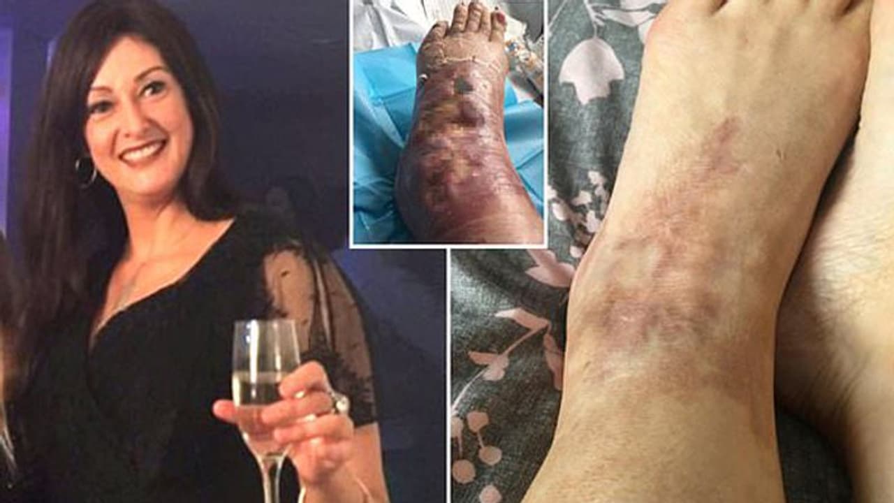 ആദ്യം കണ്ടത് വട്ടത്തിൽ ചുവന്നു തടിച്ച പാട്, രാത്രിയായപ്പോൾ ഇടത് കാൽ വീർത്തു പൊങ്ങി, ഡോക്ടറെ കണ്ടപ്പോൾ... ആദ്യം കണ്ടത് വട്ടത്തിൽ ചുവന്നു തടിച്ച പാട്, രാത്രിയായപ്പോൾ ഇടത് കാൽ വീർത്തു പൊങ്ങി, ഡോക്ടറെ കണ്ടപ്പോൾ...