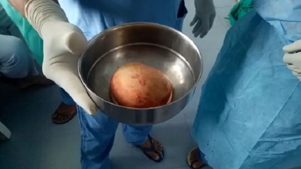 ಮೂತ್ರಪಿಂಡದಿಂದ ದಾಖಲೆ ಗಾತ್ರದ ಕಲ್ಲು ಹೊರತೆಗೆದ ವೈದ್ಯರು ಮೂತ್ರಪಿಂಡದಿಂದ ದಾಖಲೆ ಗಾತ್ರದ ಕಲ್ಲು ಹೊರತೆಗೆದ ವೈದ್ಯರು