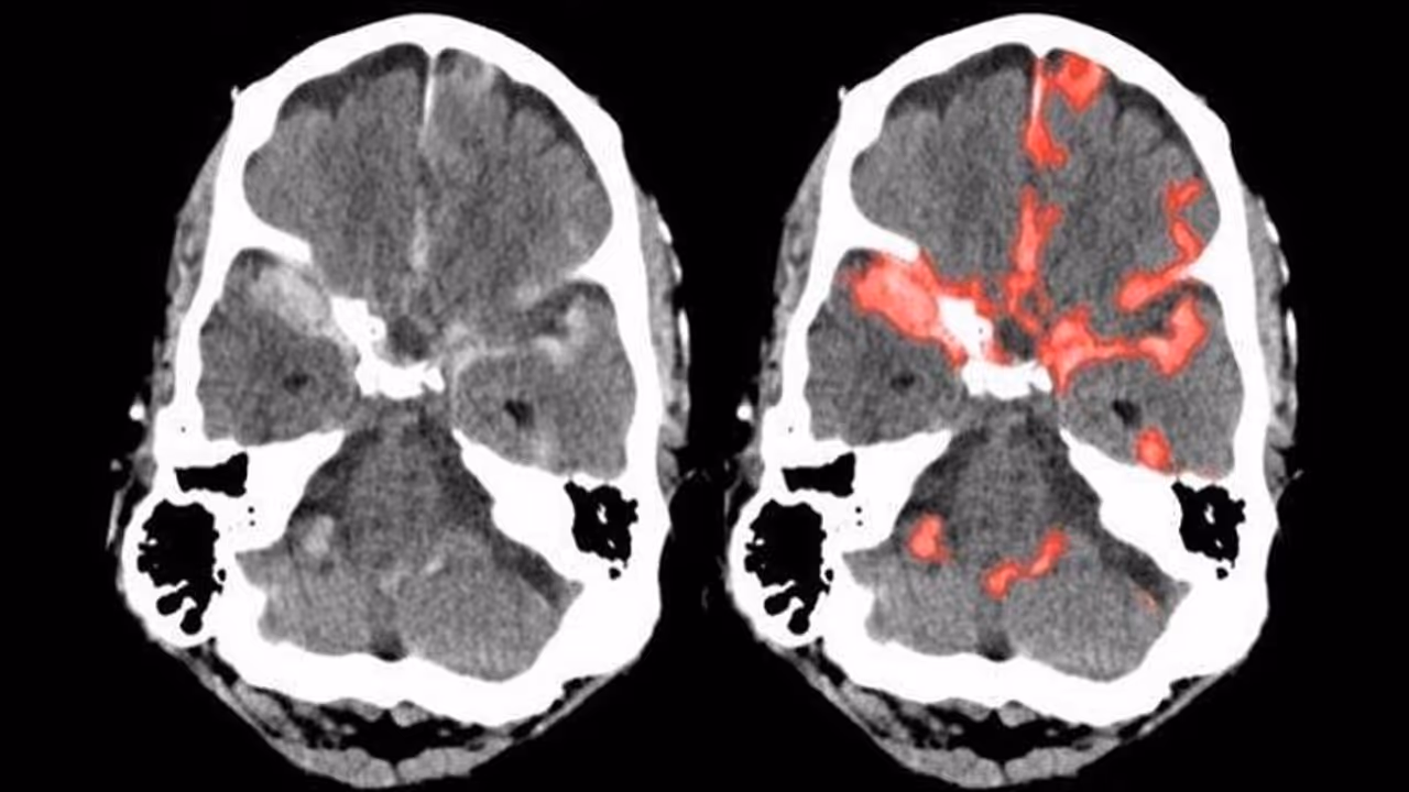 ಸೆಕೆಂಡ್ನಲ್ಲಿ ಬ್ರೈನ್ ಹ್ಯಾಮ್ರೇಜ್ ಗುರುತಿಸುವ ಯಂತ್ರ: ಭಾರತೀಯ ಮೂಲದ ವೈದ್ಯರ ಸಾಧನೆ! ಸೆಕೆಂಡ್ನಲ್ಲಿ ಬ್ರೈನ್ ಹ್ಯಾಮ್ರೇಜ್ ಗುರುತಿಸುವ ಯಂತ್ರ: ಭಾರತೀಯ ಮೂಲದ ವೈದ್ಯರ ಸಾಧನೆ!