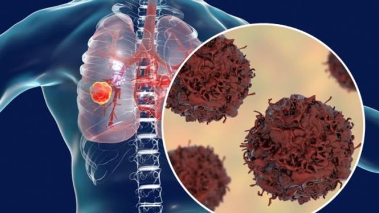 ശ്വാസകോശാര്ബുദം തടയാം; ഈ ഡയറ്റ് ശ്രദ്ധിക്കൂ... ശ്വാസകോശാര്ബുദം തടയാം; ഈ ഡയറ്റ് ശ്രദ്ധിക്കൂ...