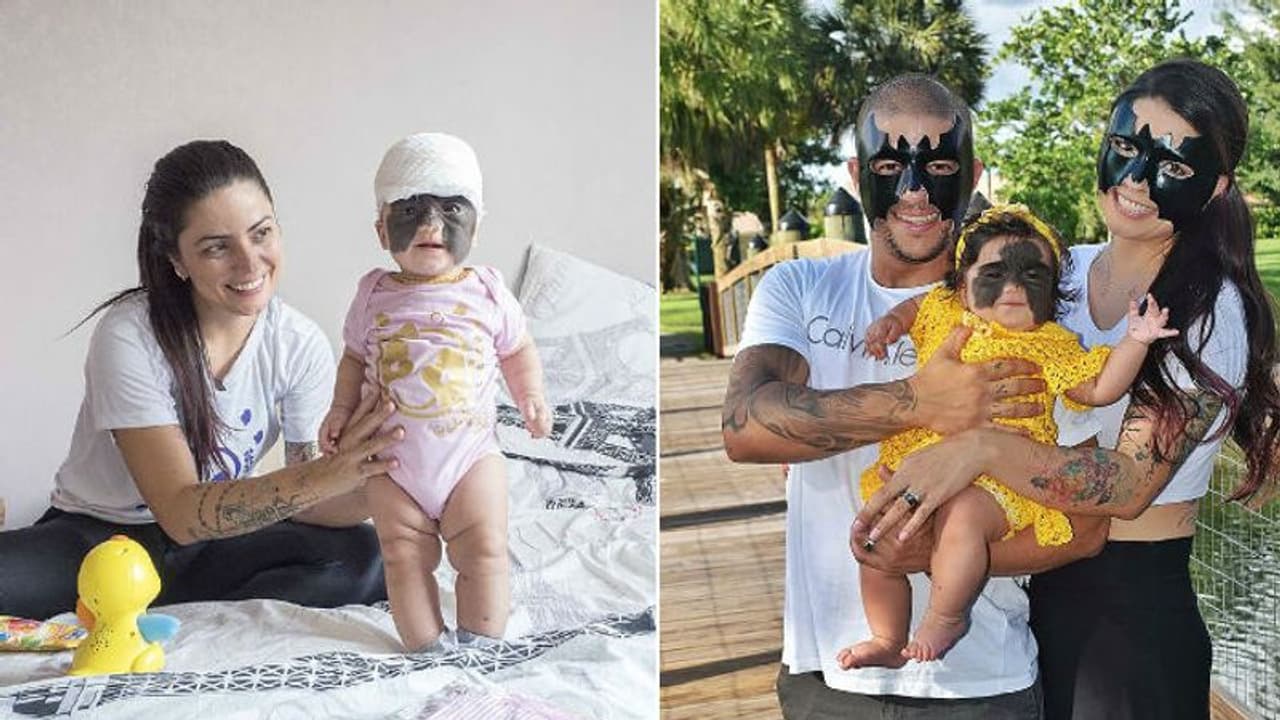 മുഖത്ത് ബാറ്റ്മാനെ ഓര്‍മ്മിപ്പിക്കുന്ന മറുകുമായി കുഞ്ഞ്; മുഖം ഒളിപ്പിക്കാതെ അച്ഛനുമമ്മയും