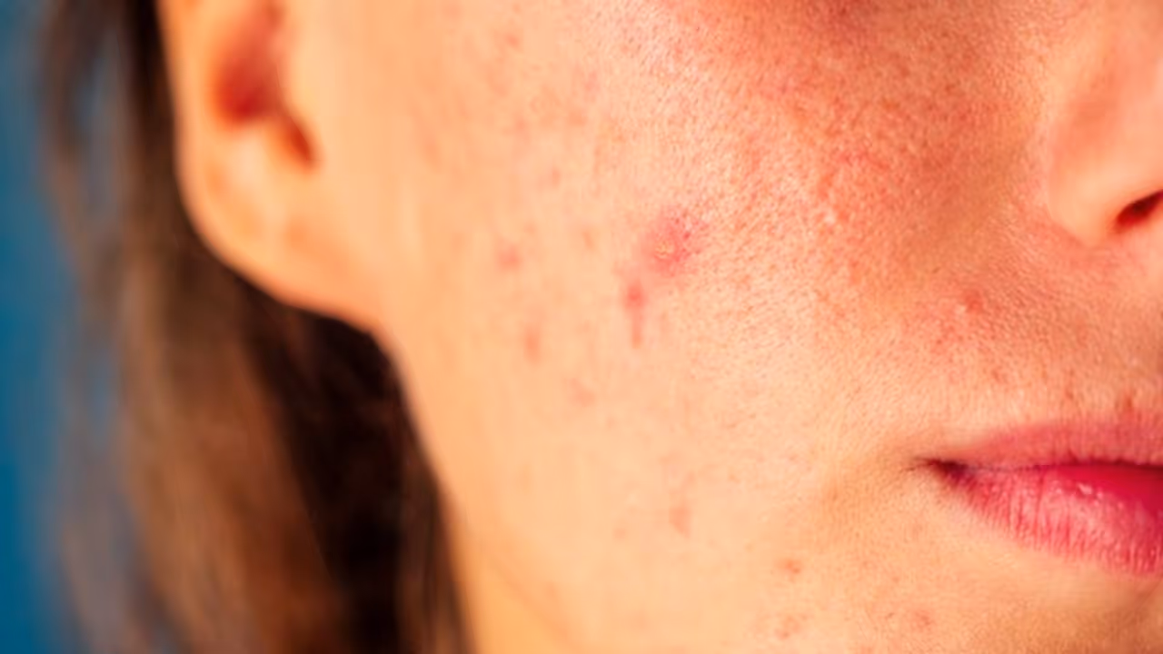 ശരീരത്തിൽ സ്ഥിരമായി കുരുക്കൾ ഉണ്ടാകാറുണ്ടോ; കാരണങ്ങൾ അറിയാം ശരീരത്തിൽ സ്ഥിരമായി കുരുക്കൾ ഉണ്ടാകാറുണ്ടോ; കാരണങ്ങൾ അറിയാം