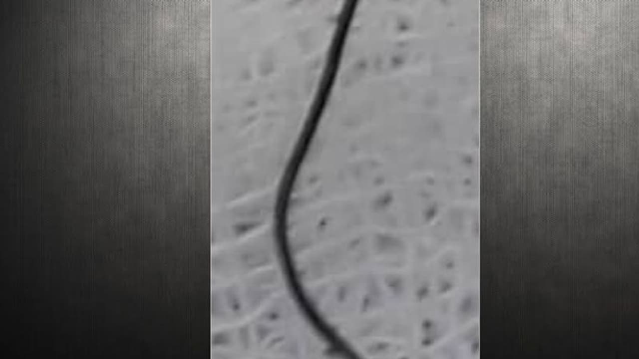 തിരുവനന്തപുരം മെഡിക്കല്‍ കോളേജില്‍ അതി സങ്കീര്‍ണ ശത്രക്രിയ; അന്നനാളത്തിനിടയില്‍ കുടുങ്ങിയ കമ്പികക്ഷണം പുറത്തെടുത്തു