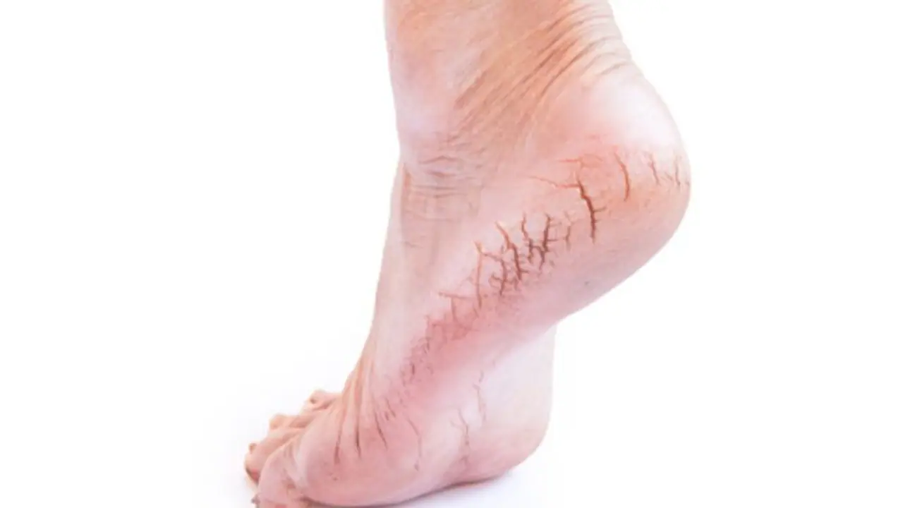 Here's how you can say goodbye to cracked heels with these home remedies