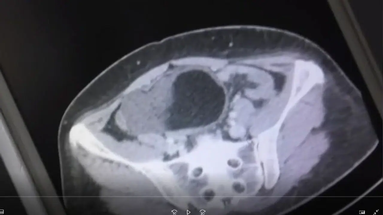 പ്രസവവേദനയെക്കാള് ഭീകരം, ഭക്ഷണമിറക്കാന് കഴിയുന്നില്ല; പരിശോധനയില് കണ്ടെത്തിയത്... പ്രസവവേദനയെക്കാള് ഭീകരം, ഭക്ഷണമിറക്കാന് കഴിയുന്നില്ല; പരിശോധനയില് കണ്ടെത്തിയത്...