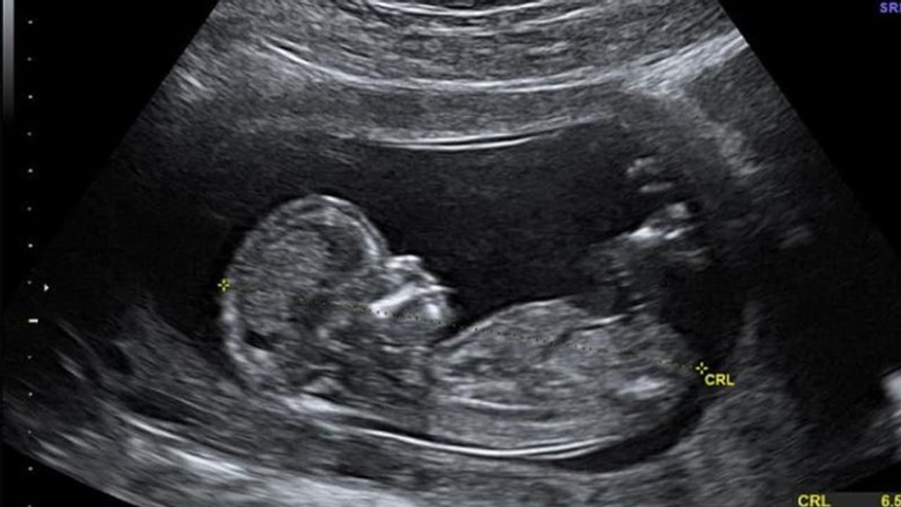 ಮೊದಲ ಬಾರಿ ಹೊಕ್ಕುಳ ಬಳ್ಳಿಯಲ್ಲೂ ಪ್ಲಾಸ್ಟಿಕ್ ಪತ್ತೆ! ಮೊದಲ ಬಾರಿ ಹೊಕ್ಕುಳ ಬಳ್ಳಿಯಲ್ಲೂ ಪ್ಲಾಸ್ಟಿಕ್ ಪತ್ತೆ!