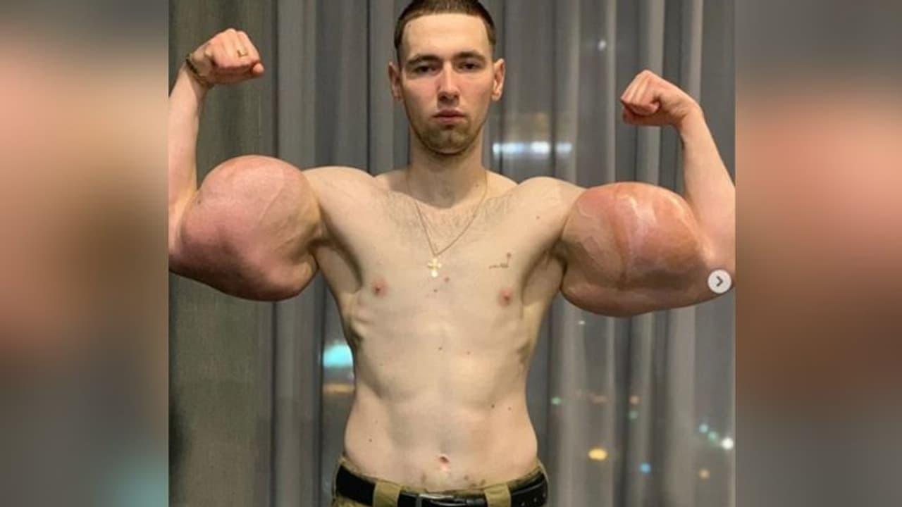 बॉडी बनाने की सनक में शख्स का हुआ खौफनाक हाल, अंदर से सड़ने लगा मांस बॉडी बनाने की सनक में शख्स का हुआ खौफनाक हाल, अंदर से सड़ने लगा मांस