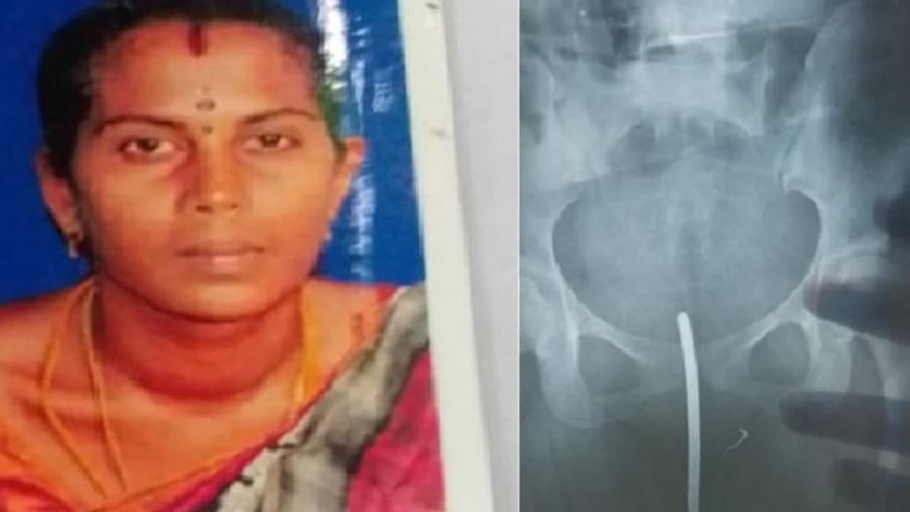 பெண்ணின் வயிற்றுக்குள் ஊசியை வைத்து தைத்த செவிலியர்கள்..! பிரசவத்தின் போது நிகழ்ந்த கொடூரம்..! பெண்ணின் வயிற்றுக்குள் ஊசியை வைத்து தைத்த செவிலியர்கள்..! பிரசவத்தின் போது நிகழ்ந்த கொடூரம்..!