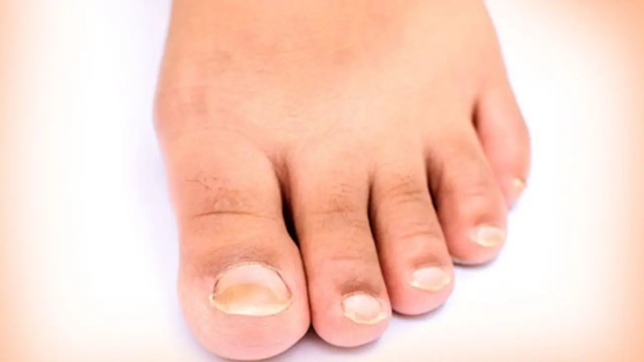 নখকুনির সমস্যায় ভুগছেন, ঘরোয়া টোটকায় মিলবে মুক্তি নখকুনির সমস্যায় ভুগছেন, ঘরোয়া টোটকায় মিলবে মুক্তি