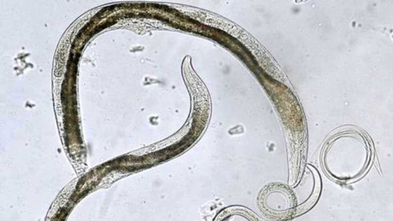 കടുത്ത തലവേദന; ചികിത്സയ്ക്കിടെ യുവാവിന്റെ ശരീരത്തില്‍ നിന്ന് കിട്ടിയത് 700 വിരകളെ!