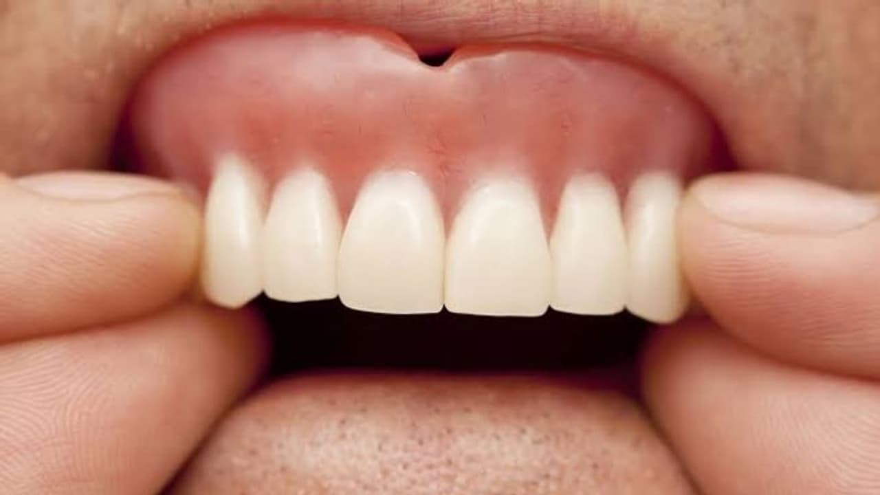 കേക്ക് കഴിക്കുന്നതിനിടെ വെപ്പ് പല്ല് കാണാതായി; എണ്പതുകാരന് സംഭവിച്ചത്... കേക്ക് കഴിക്കുന്നതിനിടെ വെപ്പ് പല്ല് കാണാതായി; എണ്പതുകാരന് സംഭവിച്ചത്...