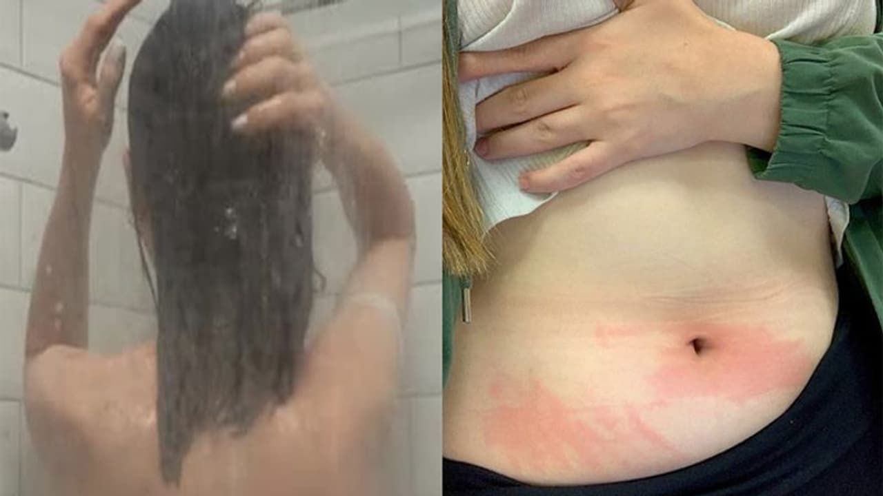 पानी से है इस लड़की को एलर्जी, आंसू तक से शरीर पर पड़ जाते हैं फोड़े पानी से है इस लड़की को एलर्जी, आंसू तक से शरीर पर पड़ जाते हैं फोड़े